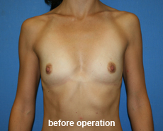 plastic-surgery-breast-augmentation